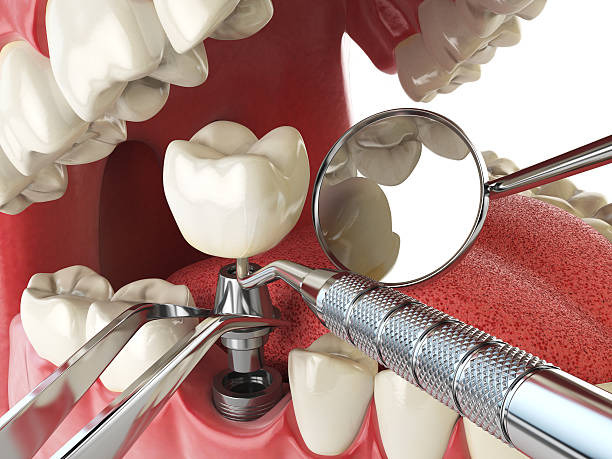 Best Urgent Tooth Repair  in Nett, MO